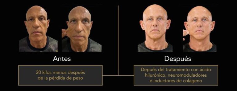 La otra cara del éxito de los GLP-1: el nuevo reto de la medicina estética